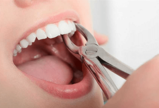 Tooth Extraction